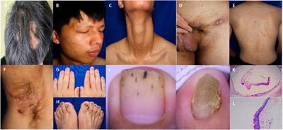 The variant c.274A>G (p.Asn92Asp) in KRT17 in a patient with pachyonychia congenita and a novel clinical feature of acne inversa